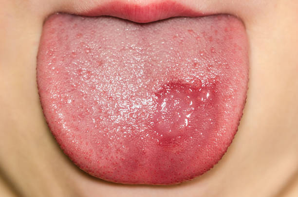What are the Symptoms of Burning Mouth Syndrome and the Treatment for Burning Mouth Syndrome?
