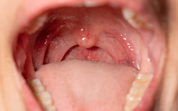 What are the Symptoms of White Patches on Tonsils and the Treatment for White Patches on Tonsils?