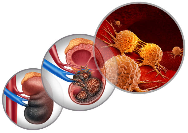 What are the Symptoms and Signs of Kidney Cancer and the Treatment for Kidney Cancer?