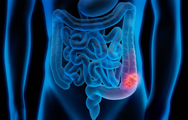 What are the Symptoms of Colon Cancer and the Treatment for Colon Cancer?
