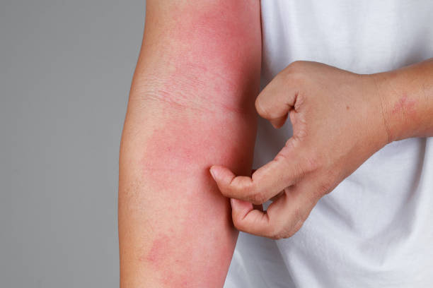 What are the Symptoms of Skin Allergy and the Treatment for Skin Allergy?