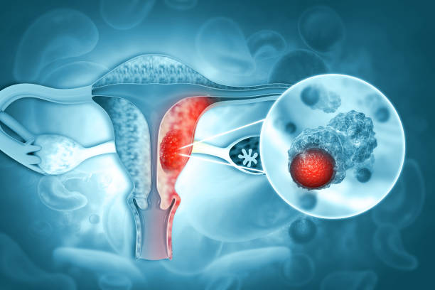 What are the Symptoms and Signs of Uterine Cancer and the Treatment for Uterine Cancer?