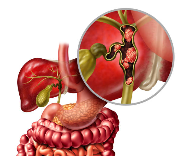 What are the Symptoms of Bile Duct Cancer and the Treatment for Bile Duct Cancer?