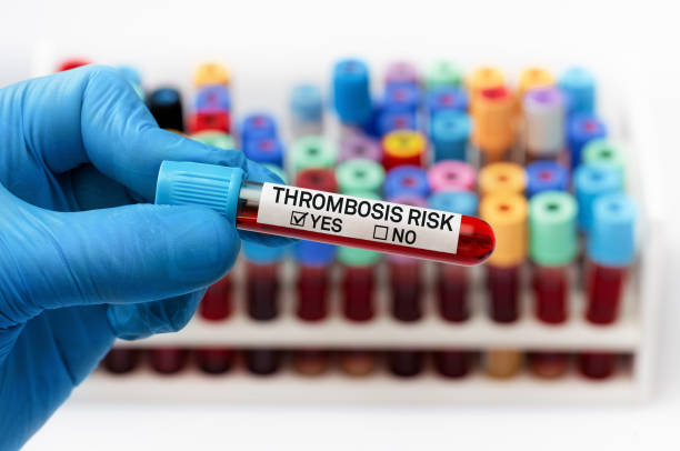 What are the Symptoms of Thrombocytopenia and the Treatment for Thrombocytopenia?