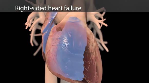 What are the Symptoms of Right Sided Heart Failure and the Treatment for Right Sided Heart Failure?