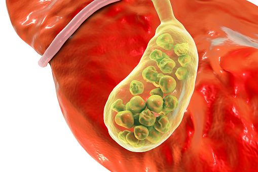 What are the Symptoms of Gallbladder Disease and the Treatment for Gallbladder Disease?