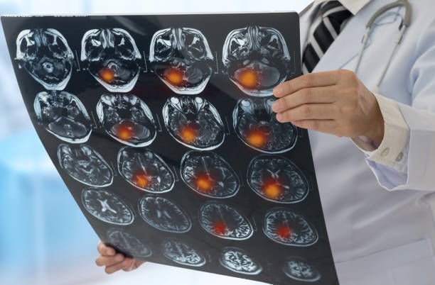 What are the Symptoms of Brain Tumor and the Treatment for Brain Tumor?