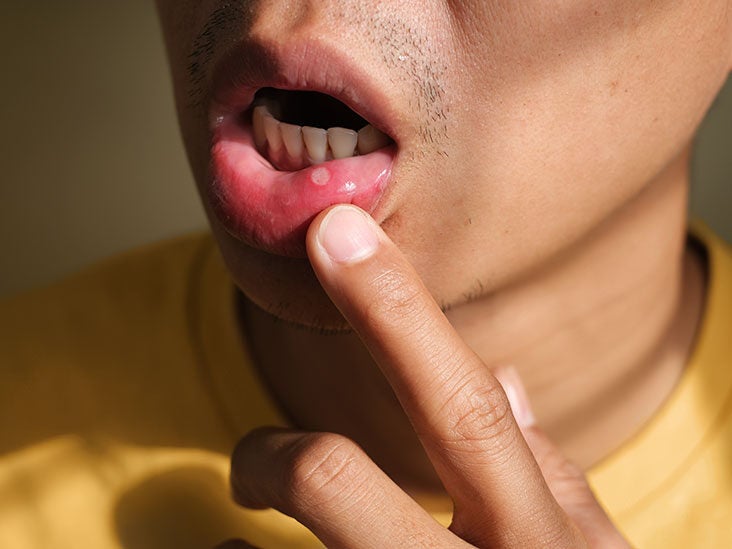 What are the Symptoms of Burning Mouth and the Treatment for Burning Mouth?