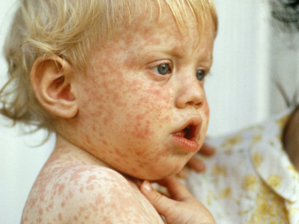 What are the Symptoms of Measles Rash and the Treatment for Measles ...