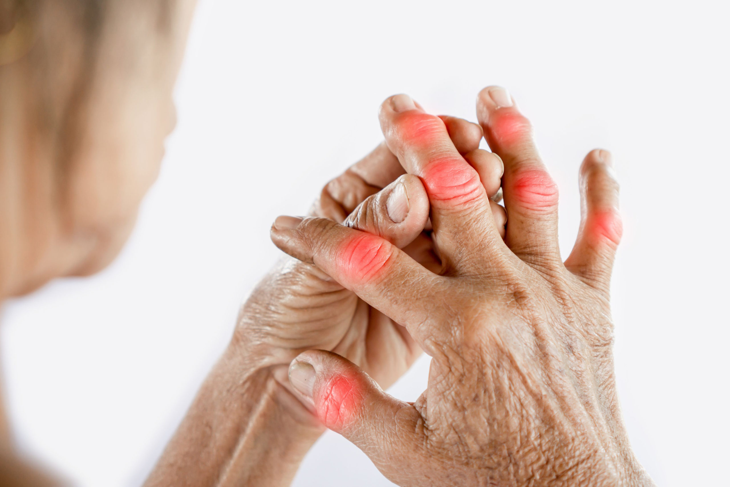 What are the Symptoms of Psoriatic Arthritis and the Treatment for Psoriatic Arthritis?