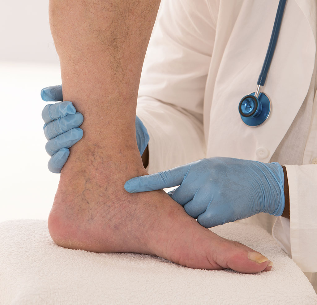 What are the Symptoms of Blood Clot in Leg and the Treatment for Blood Clot in Leg?