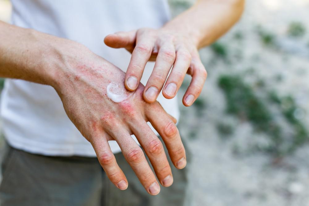 What are the Symptoms of Eczema and the Treatment for Eczema?