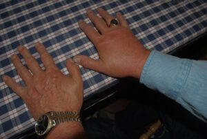 What are the Symptoms of CRPS and the Treatment for CRPS?