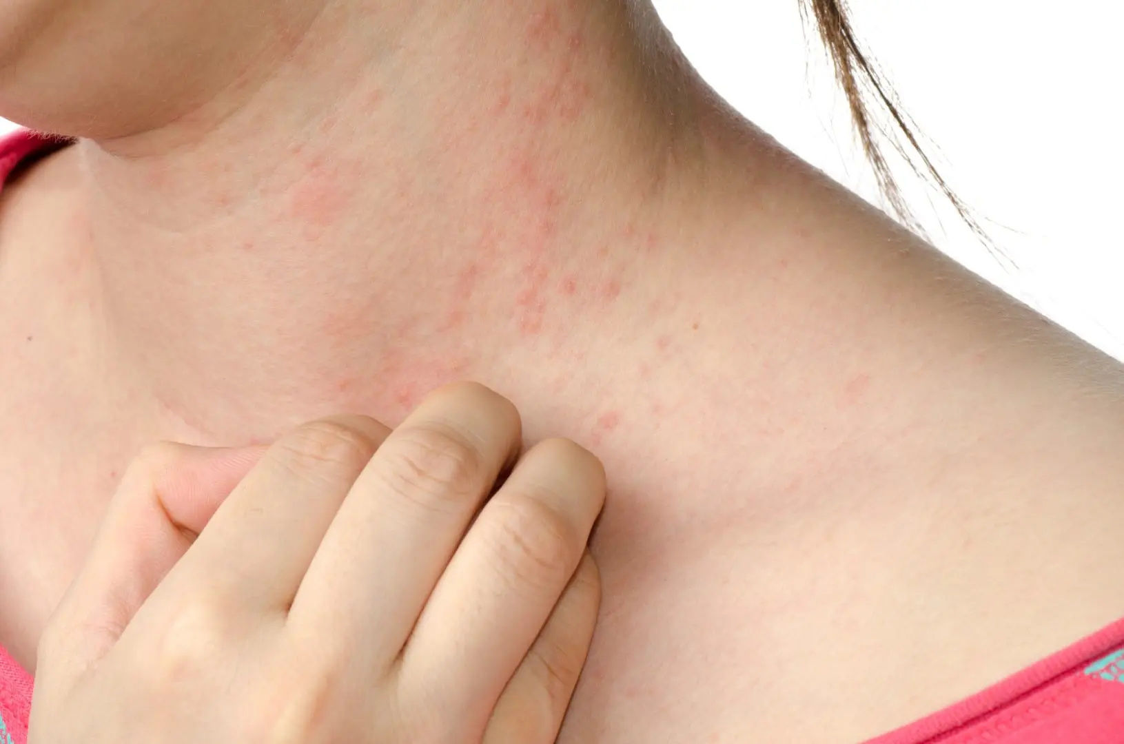 What are the Symptoms of Eczema and the Treatment for Eczema?