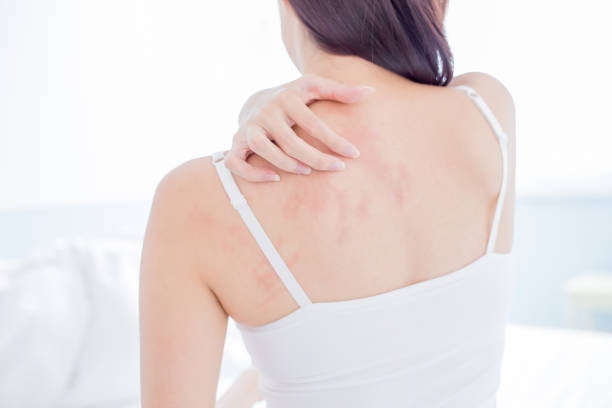 What are the Symptoms of Tingling and Itchy Skin All Over Body and the Treatment for Tingling and Itchy Skin All Over Body?