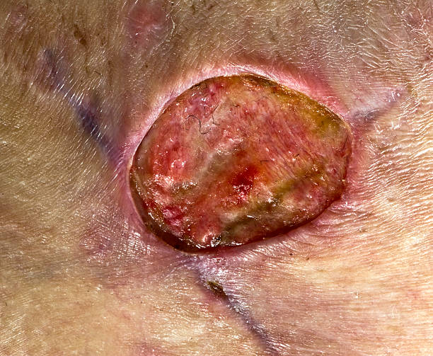 What are the Symptoms of Mucormycosis and the Treatment for Mucormycosis?