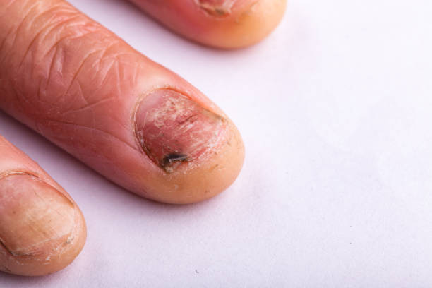 What are the Symptoms of Fungal Infection and the Treatment for Fungal Infection?