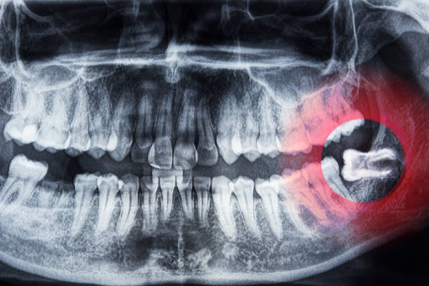 What are the Symptoms of Wisdom Tooth Pain and the Treatment for Wisdom Tooth Pain?