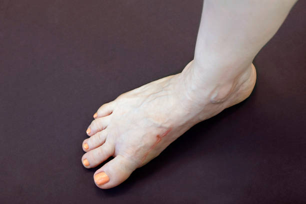 What are the Symptoms of Swelling on Top of Foot and the Treatment for Swelling on Top of Foot?