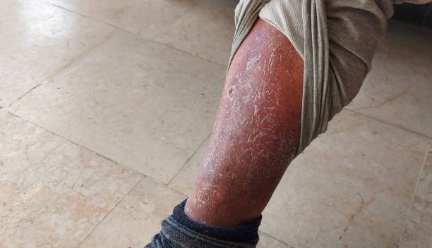 What are the Symptoms of Gangrene and the Treatment for Gangrene?