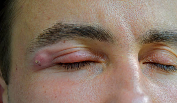 What are the Symptoms of Swelling on Cheekbone Under Eye and the Treatment for Swelling on Cheekbone Under Eye?