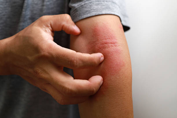 What are the Symptoms of Atopic Dermatitis and the Treatment for Atopic Dermatitis?