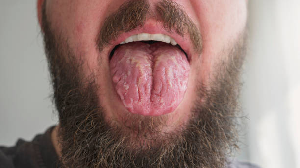 What are the Symptoms of Burning Tongue Syndrome and the Treatment for Burning Tongue Syndrome?