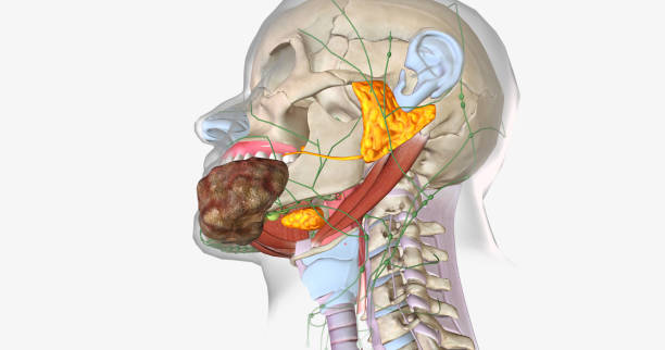 What are the Symptoms of Salivary Gland Cancer and the Treatment for Salivary Gland Cancer?