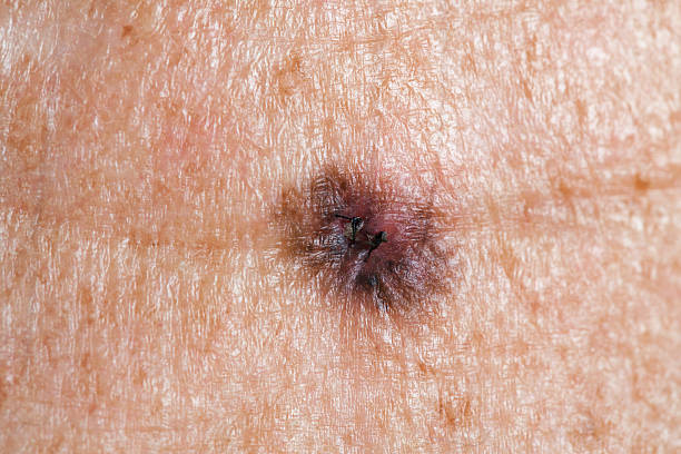 What are the Signs and Symptoms of Melanoma and the Treatment for Melanoma?