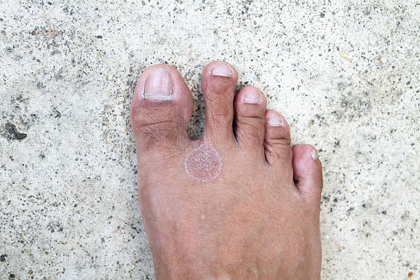 What are the Symptoms of Unexplained Blisters on Feet and the Treatment for Unexplained Blisters on Feet?