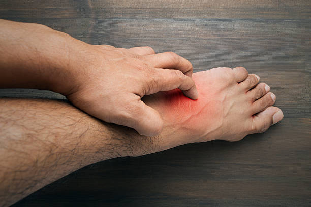 What are the Symptoms of Burning Feet Syndrome and the Treatment for Burning Feet Syndrome?