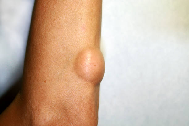 What are the Symptoms of Lipoma and the Treatment for Lipoma?